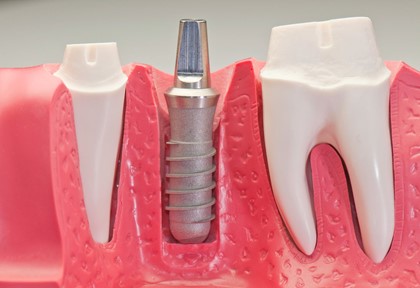Имплантация зубов 