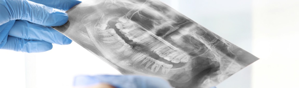 Рентген — снимок зуба