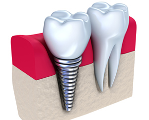 Имплантация зубов All-On-6