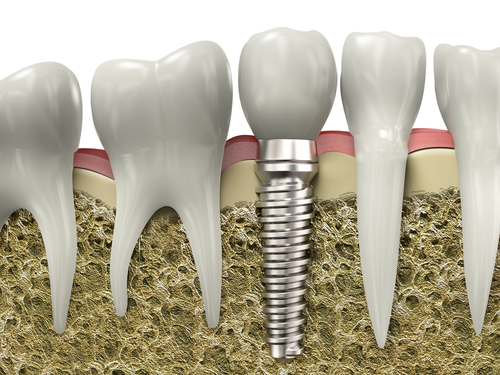 Преимущества имплантации зубов