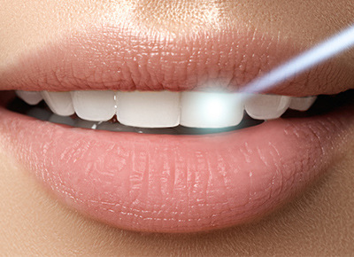 Процедуры с использованием лазера в стоматологии Mira