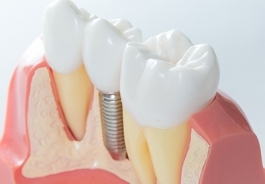имплантация зубов