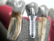 Зубной имплант следит за пациентом