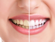 Новая услуга в стоматологии Mira: отбеливание Zoom