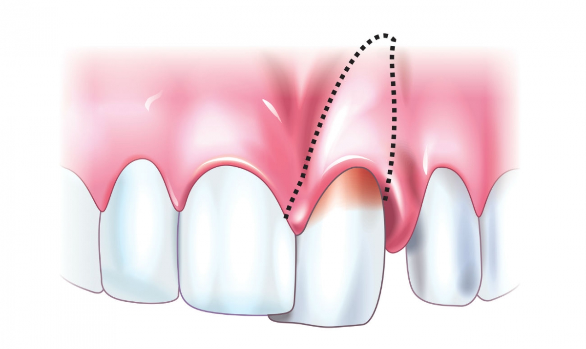 Какие бывают травмы зуб