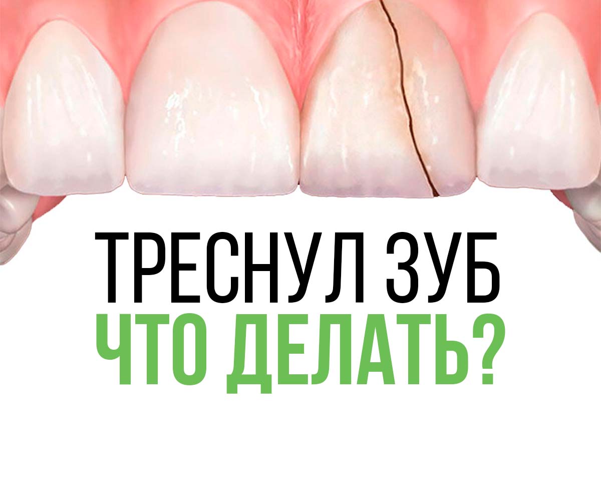 Что делать, если треснул зуб?