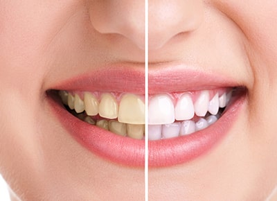 Вредно ли отбеливание зубов?
